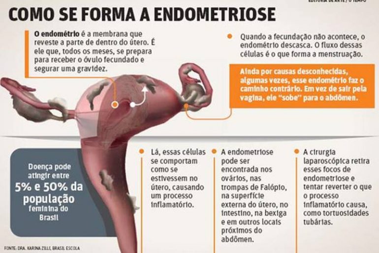 Voc Sabe O Que A Endometriose Tribuna De Parna Ba